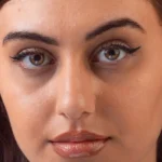 Under Eye Dark Circles: Causes and Advanced Treatment Options