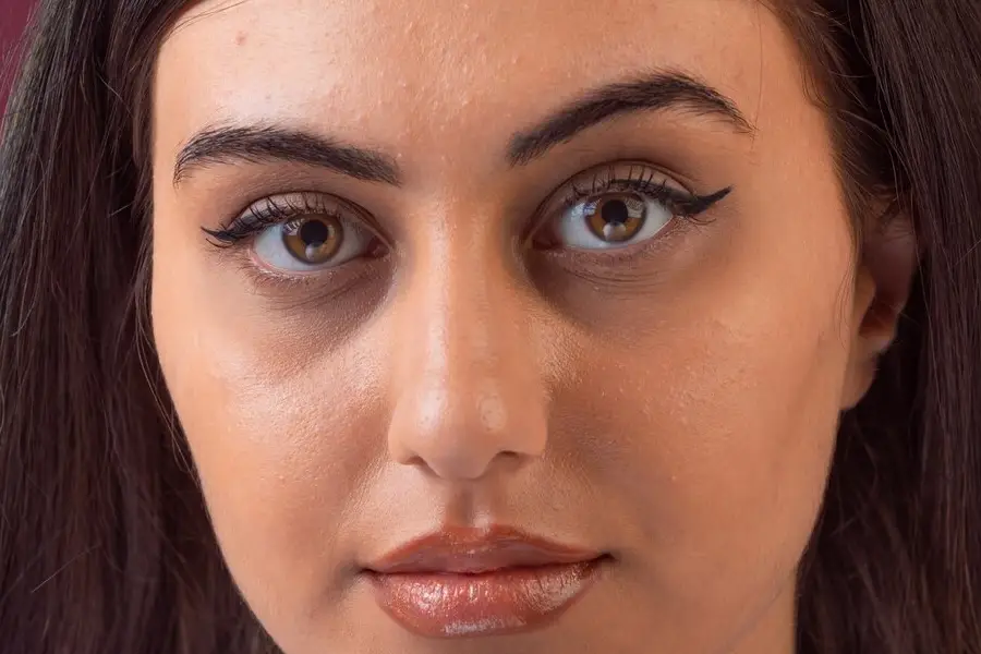 Under Eye Dark Circles: Causes and Advanced Treatment Options