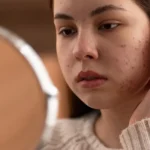 Hormonal Acne in Adults: Causes, Treatment, and Prevention Tips Hormonal Acne in Adults: Causes, Treatment, and Prevention Tips