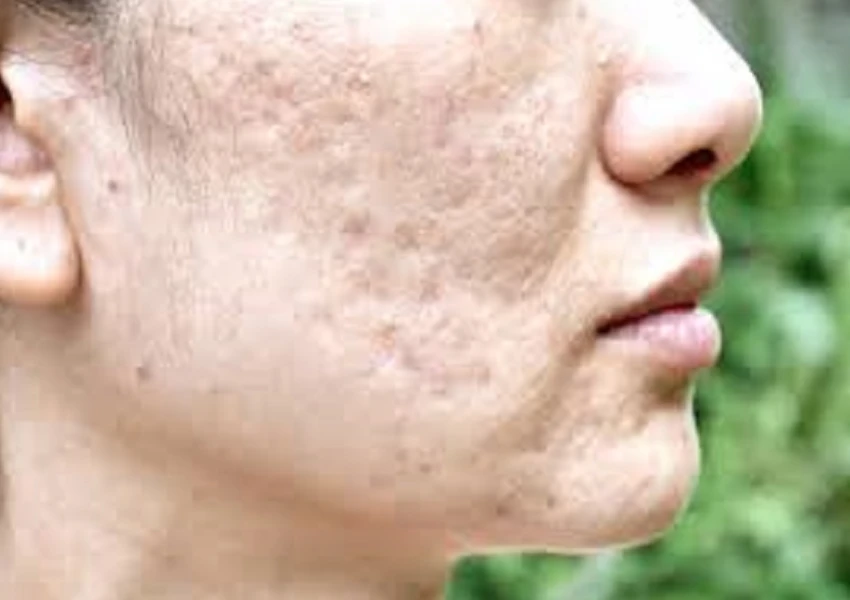 Acne Scars