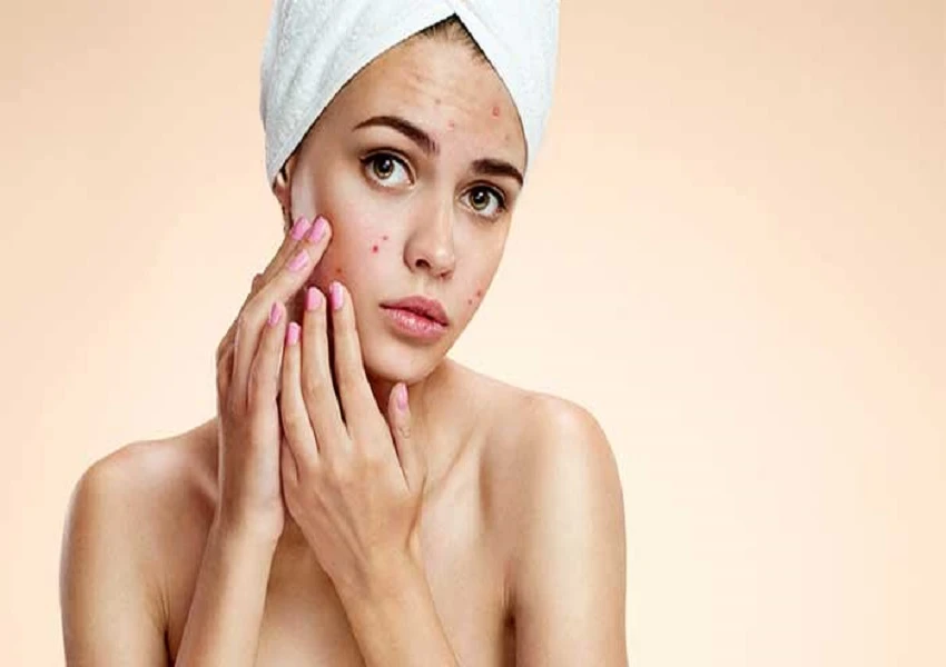 Acne Treatment