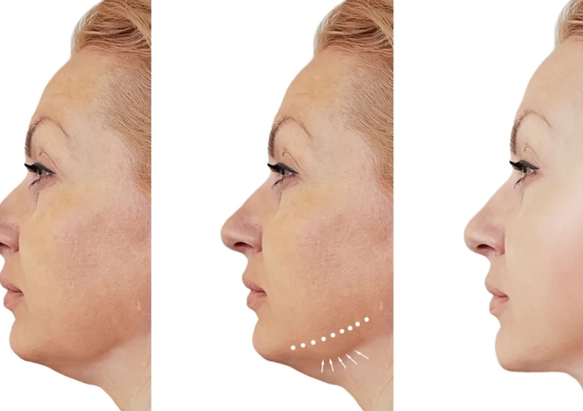 Double Chin Reduction