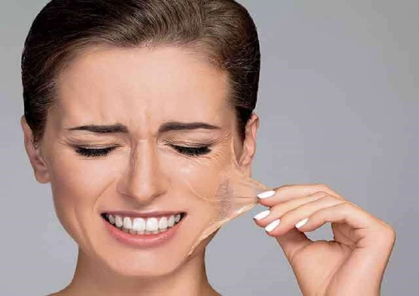 Facial Peels