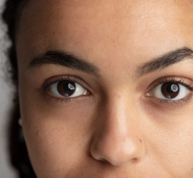 dark circles