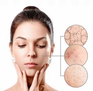 microdermabrasion
