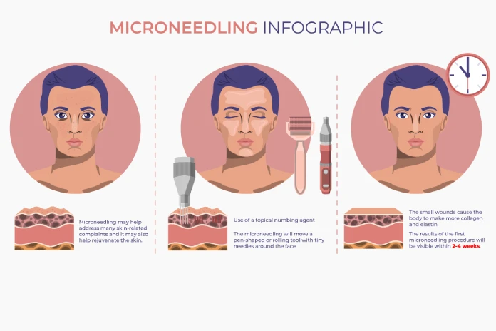microneedling info
