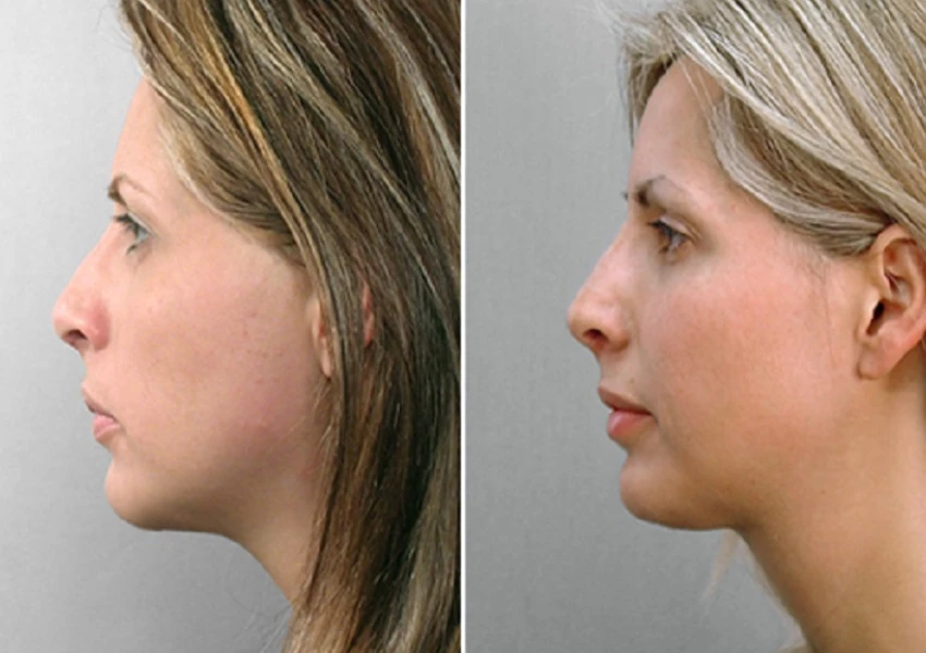 small chin