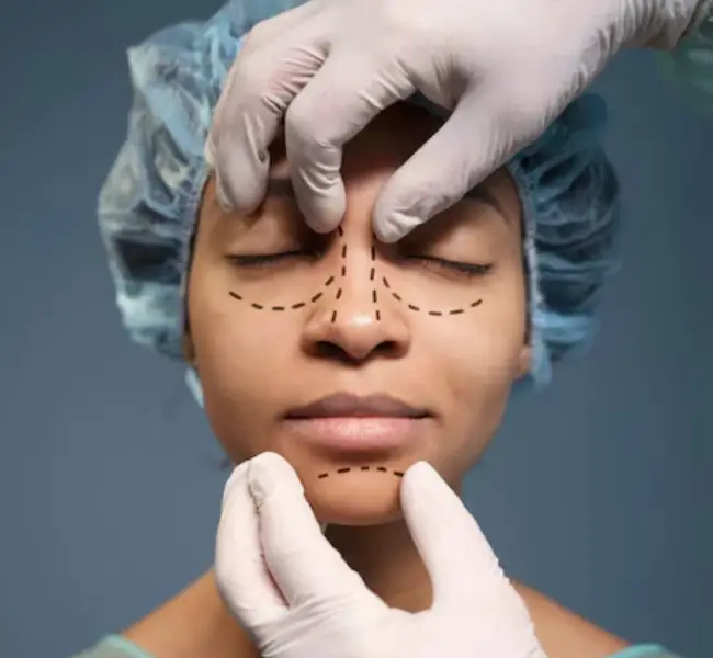 Thread Lift Treatment in Jayanagar