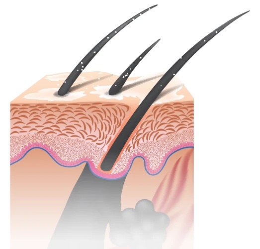 Dandruff Treatment