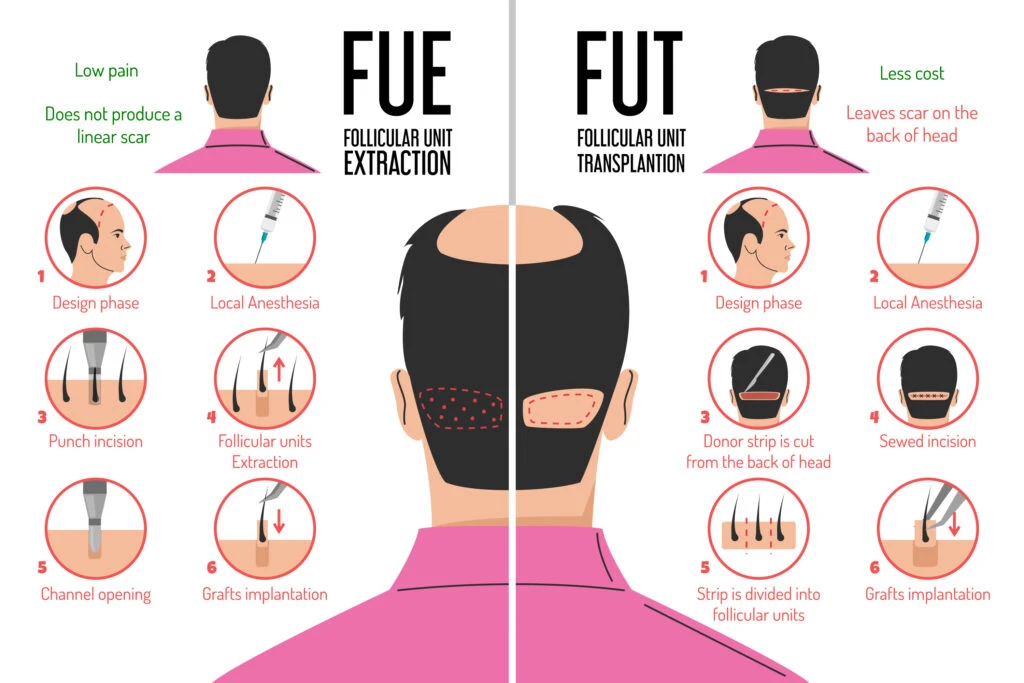 FUE FUT Hair transplant
