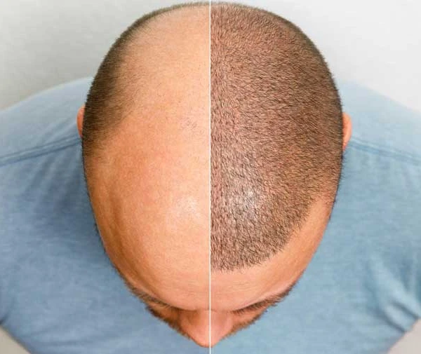 Hair Transplant Clinic in Bangalore