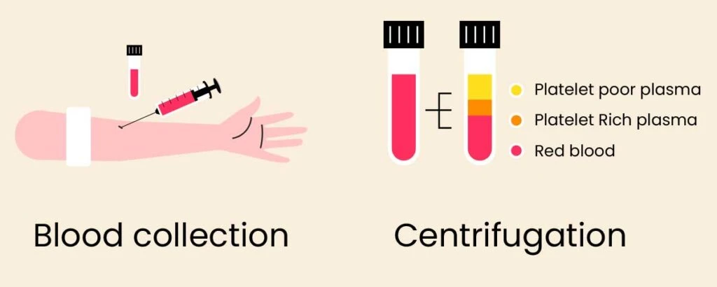 Platelet Rich Plasma Separation