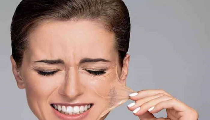 chemical peel
