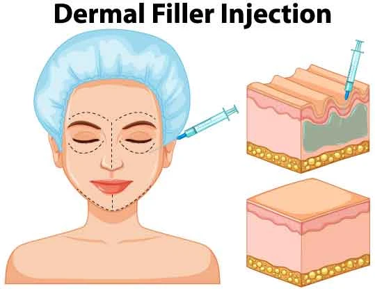 dermal filler injection