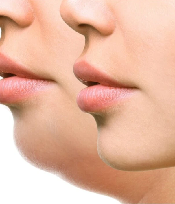 Why Consider Getting A Double Chin Correction Treatment?