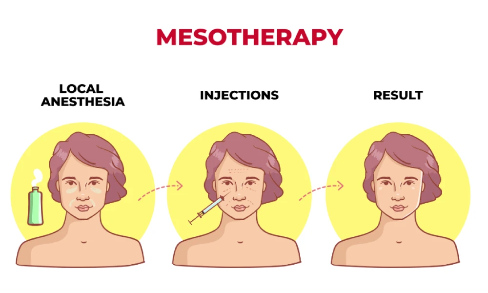 Mesoglow Treatment