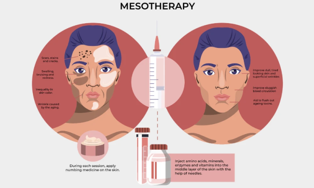 mesotherapy