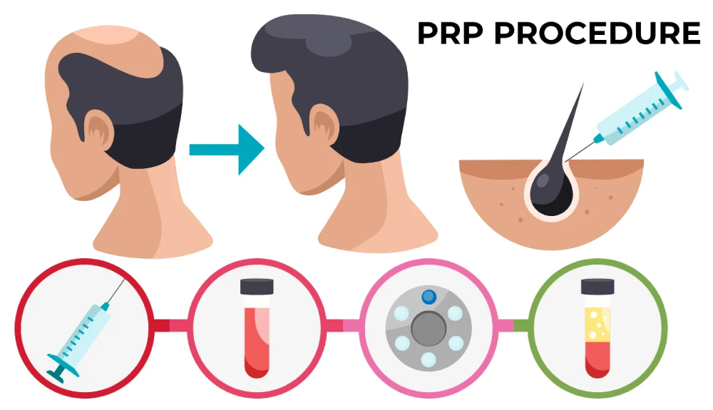 p-rp procedure